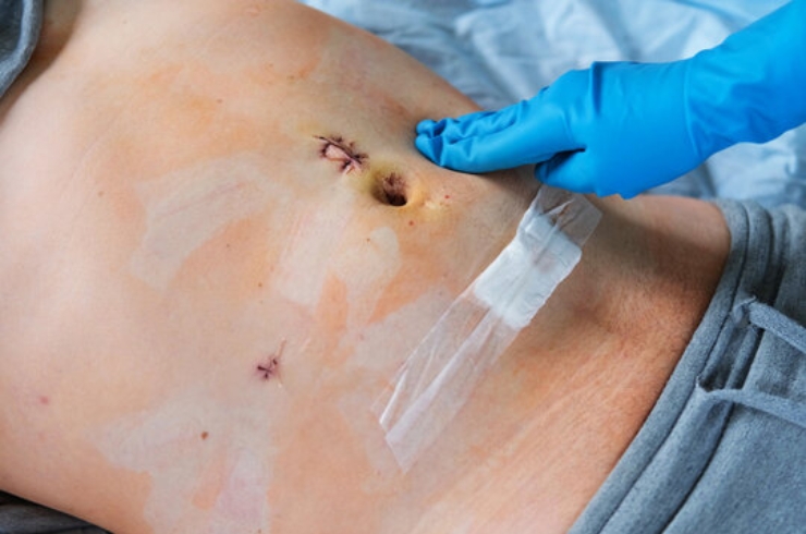 Appendectomy