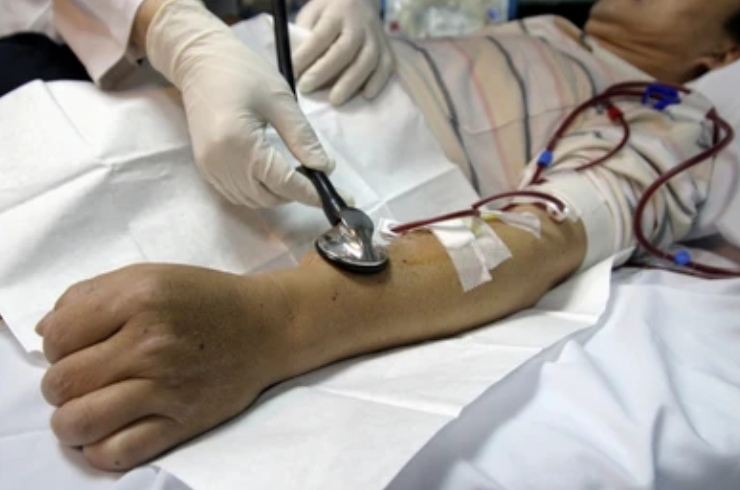 Fistula Surgery------14