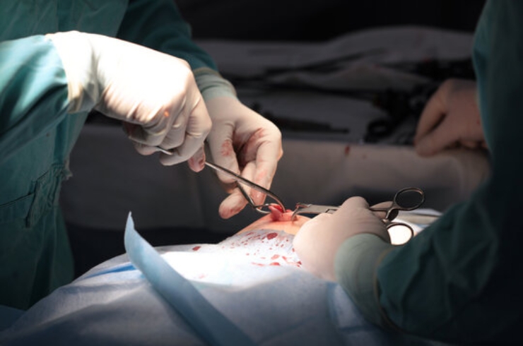 Hernia Surgery