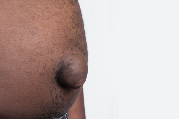 Incisional Hernia-------14