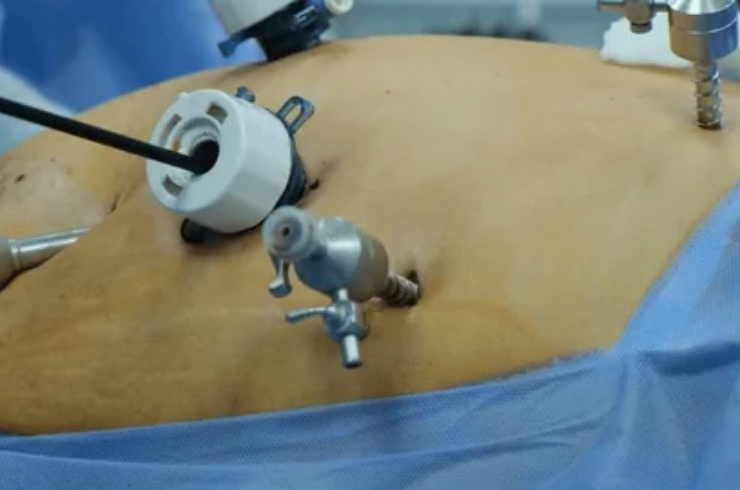 Laparoscopic Cholecystectomy