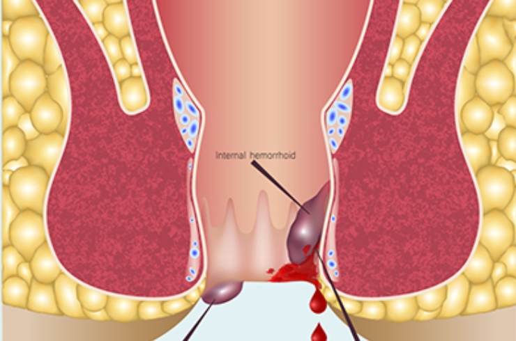 Laser Fistula Treatment------14